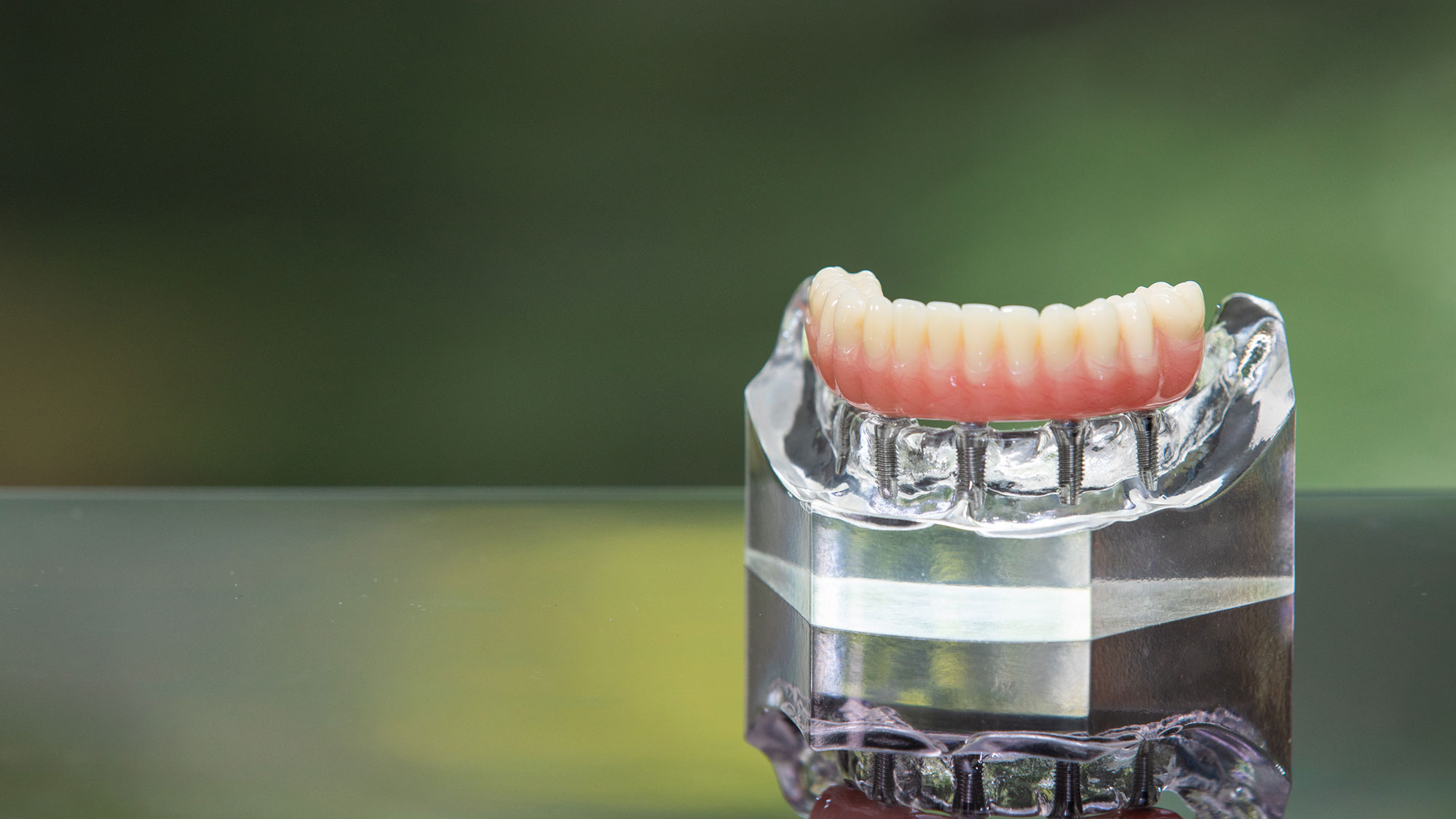 Dental Implant model Neosho, MO