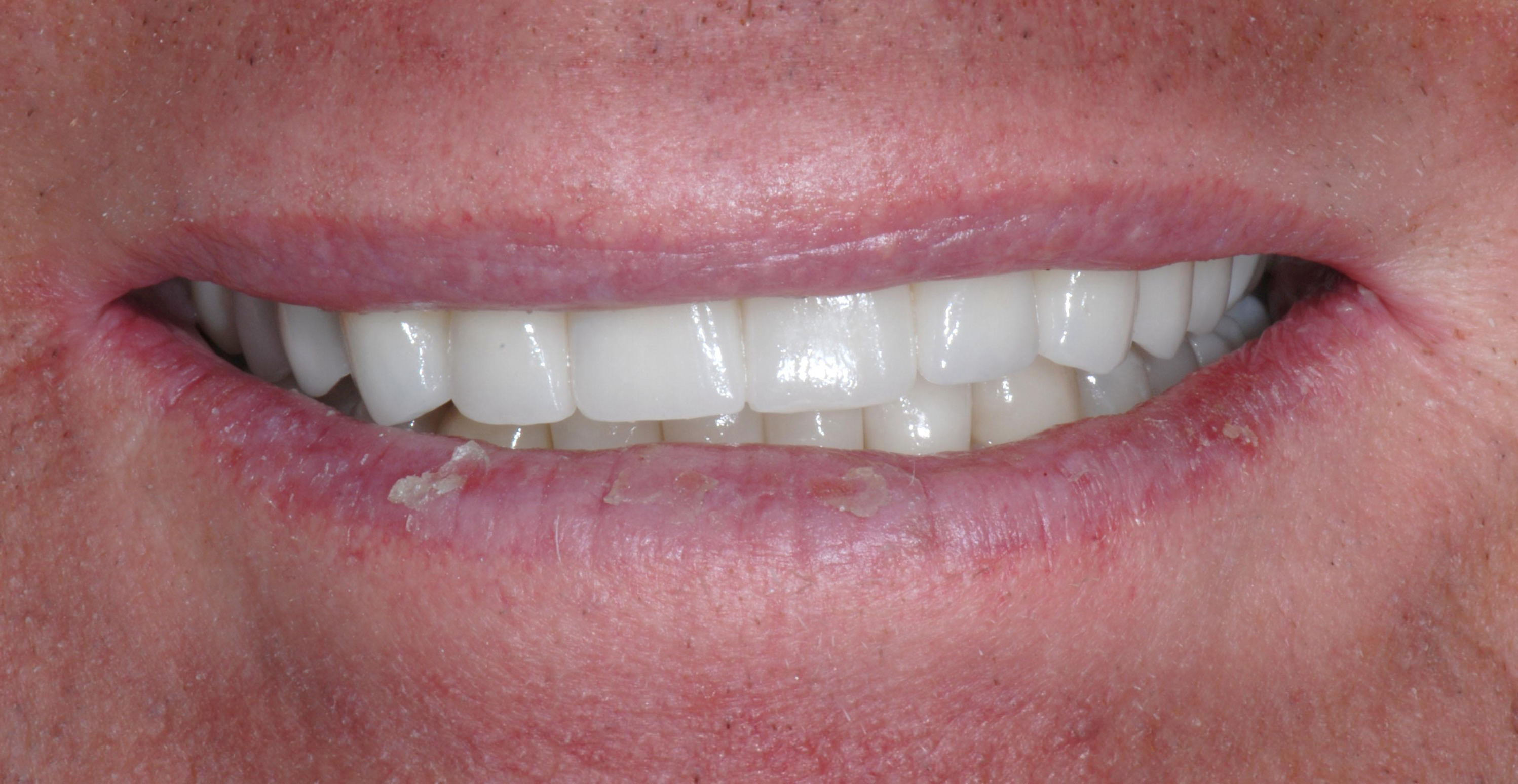 Full smile reconstruction case after - Neosho, MO