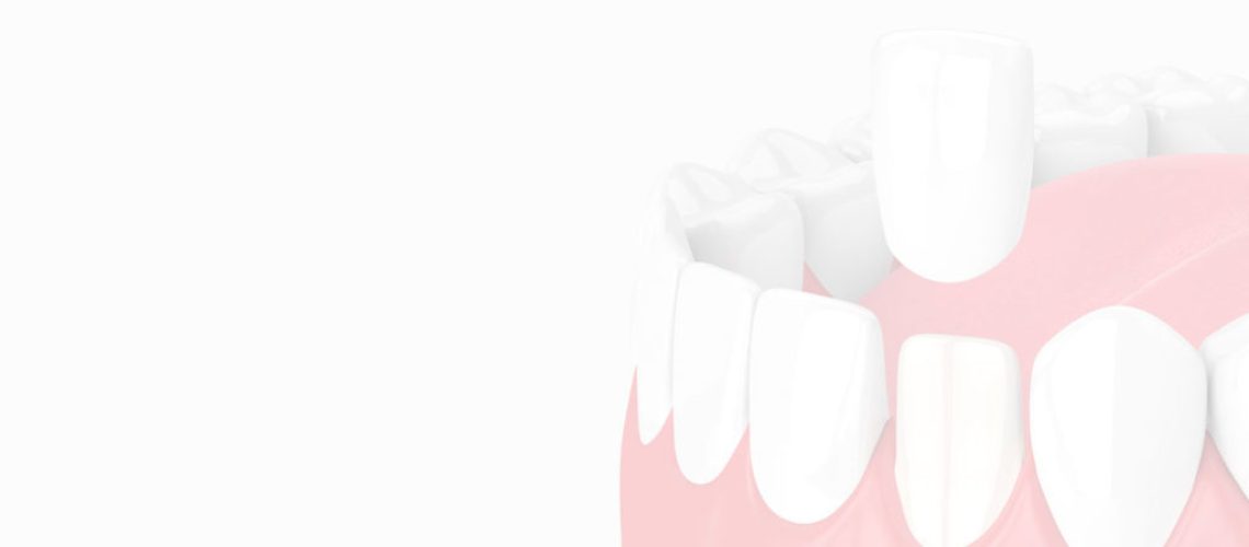 Veneers graphic - Neosho, MO